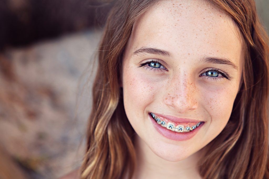 Close-up of a smiling freckled girl with long auburn hair and metal braces, Hulse Orthodontics, Carlsbad CA