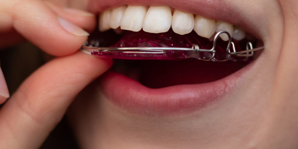 girl with a retainer