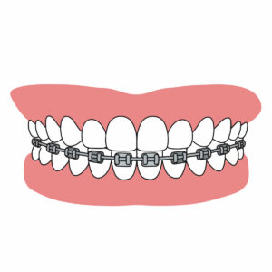 braces bottom teeth